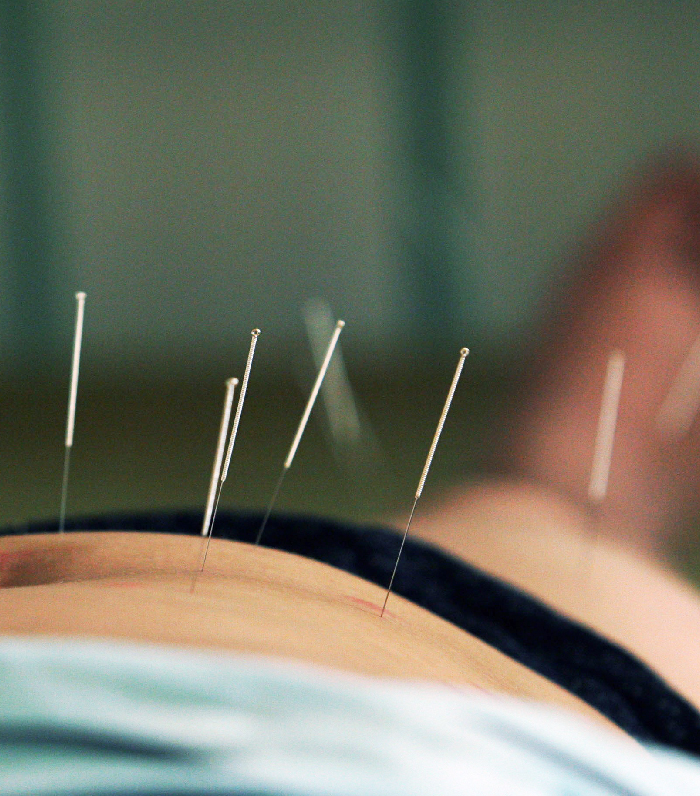 Acupuncture for Bloating