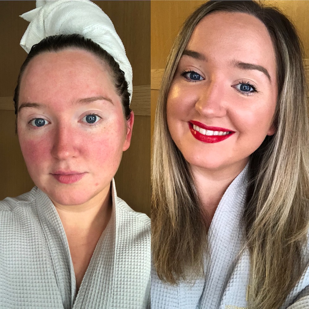 Rosacea: Rose Gallagher before and after anti-redness products