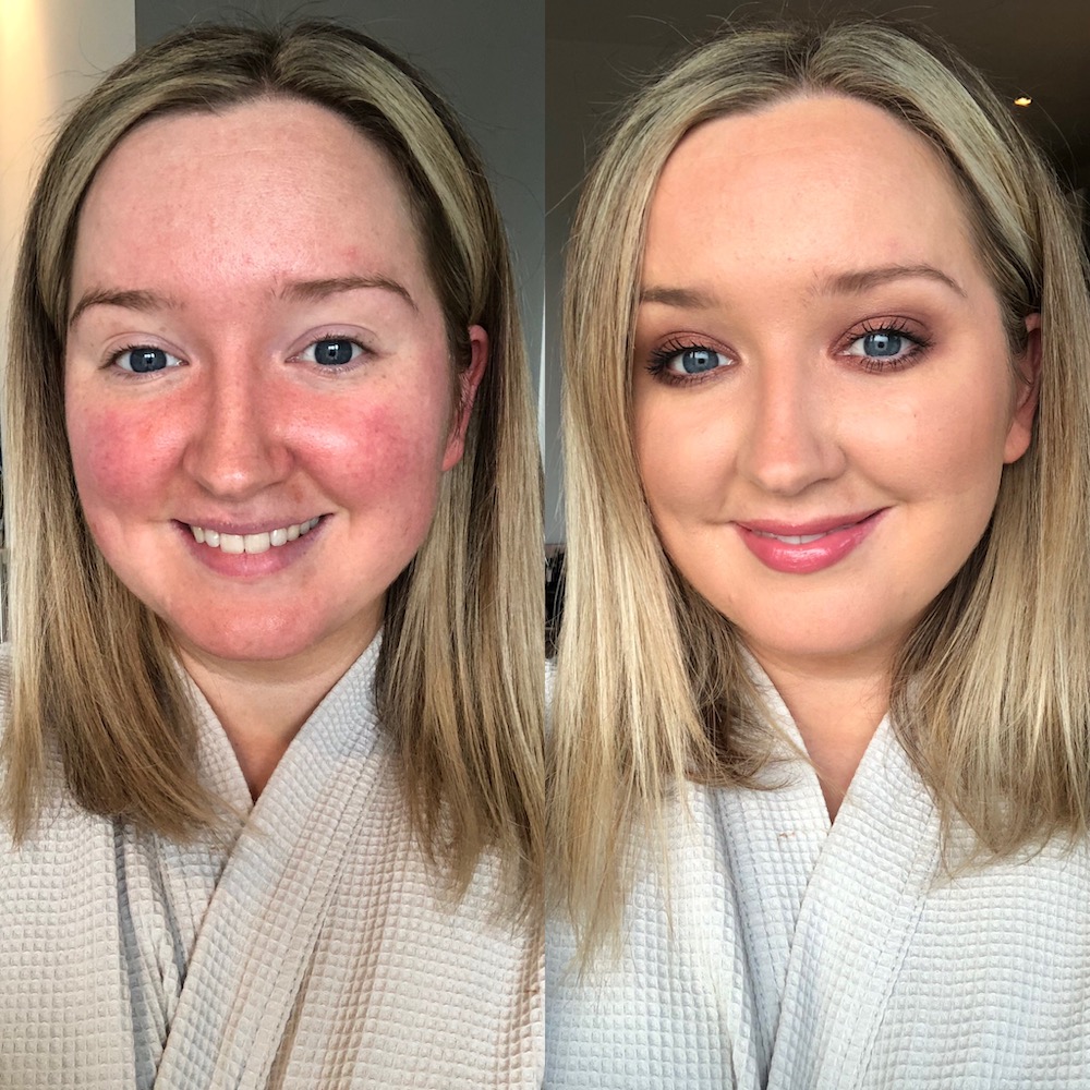 Rosacea: Rose Gallagher before and after anti-redness products