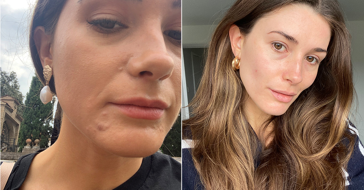 I Tried Everything for Acne, But This Dermatologist Recommendation Worked